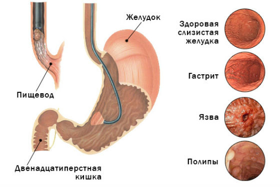 Виды и формы заболеваний желудка