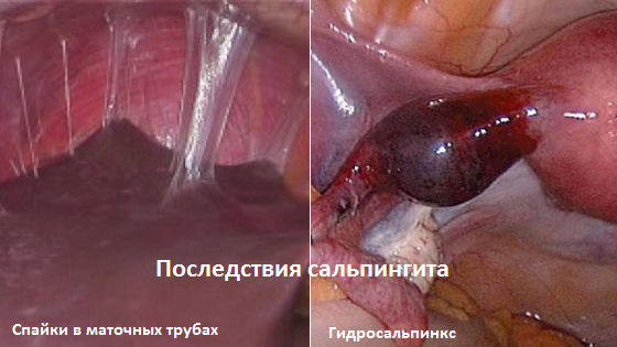 Осложнения воспаления маточных труб