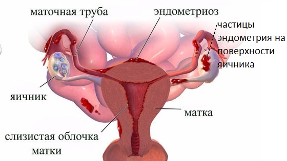 Причины образования в яичниках полостей, заполненных кровью