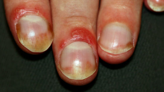 Псориатическое поражение с воспалением вокруг ногтевой пластины