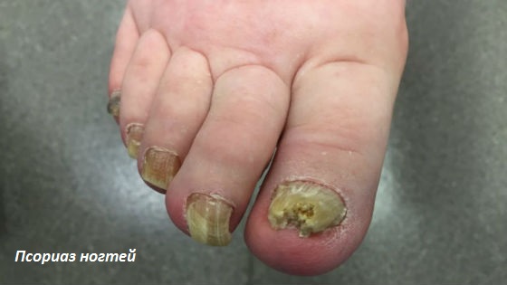 Псориатическое поражение ногтевой пластины на ногах