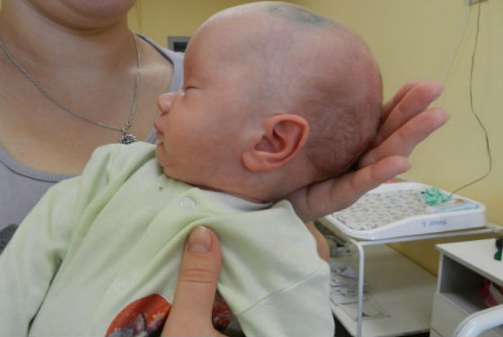 Голова малыша после лечения водянки мозга