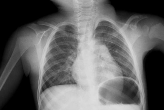 Затемнение на рентгеновском снимке при пневмонии