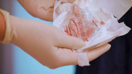 Выделения крови после менструации могут быть очень сильными