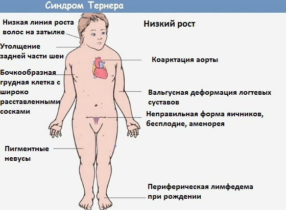 Синдром Шерешевского-Тернера