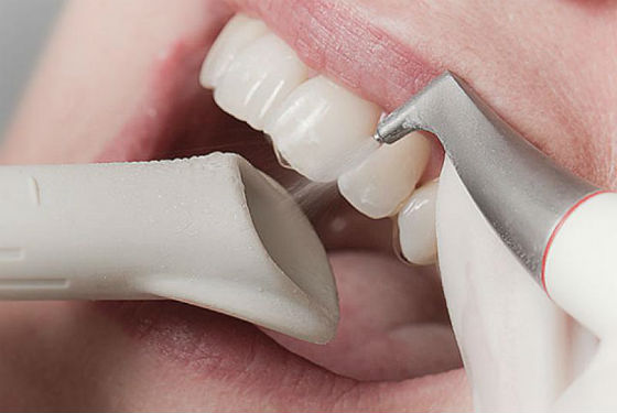 После процедуры зубную эмаль тщательно очищают от геля