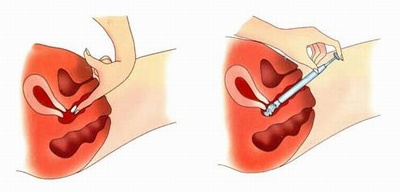 Способ применения противозачаточных вагинальных таблеток