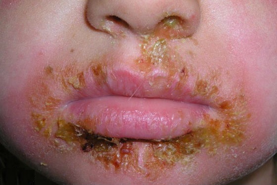 Поражение стафилококковой инфекцией кожи вокруг рта
