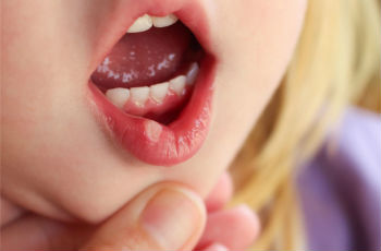 Воспаление слизистой рта у ребенка