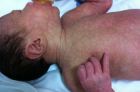 Мраморная кожа у детей первых месяцев жизни