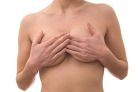 Растяжки на груди, причины, как избавиться, косметологические и домашние методы, профилактика