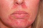 Проявление себорейного дерматита на коже лица