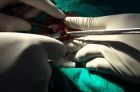 Удаление фиброаденомы молочной железы с помощью хирургической операции