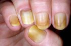 Желтые ногти на руках, причины появления, методы устранения, отбеливание ногтей в домашних условиях