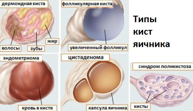 Разновидности кистозных образований в яичниках