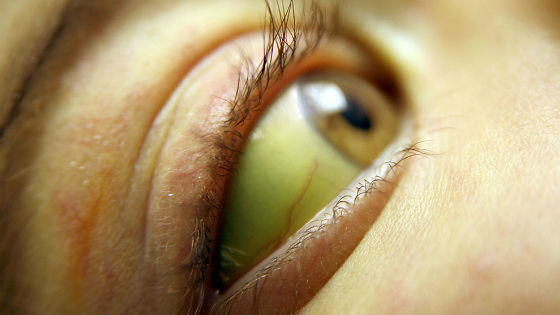 Пжелтение белков глаз при заражении токсоплазмой