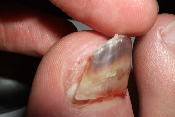 Травматическое поражение ногтевой пластины