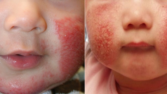 Аллергия при неправильной терапии перестает в мокнущие экземы