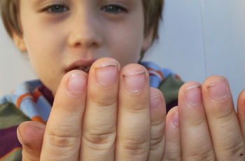 Почему происходит слоение ногтевой пластины у детей