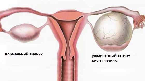 Увеличенный яичник у женщины причины 24