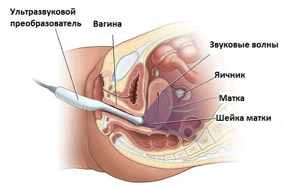 Диагностика заболеваний маточной полости проводится в помощью трансвагинального УЗИ