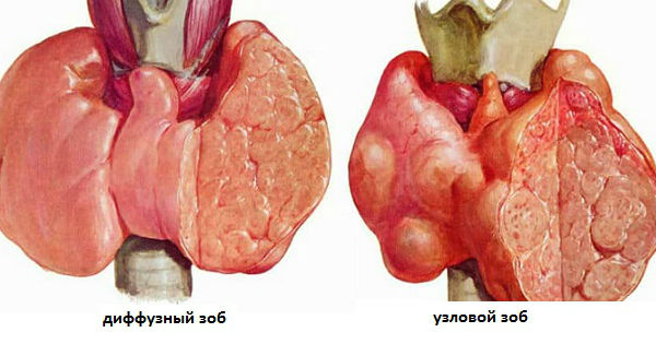 Разрастание щитовидки диффузное и узловое