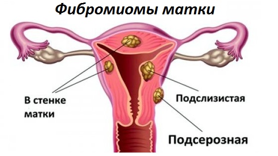 Основные виды фибромиоматозных узлов