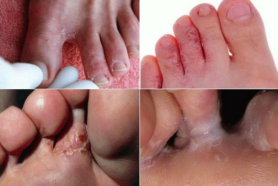 Различные виды растрескивания кожи на ступнях