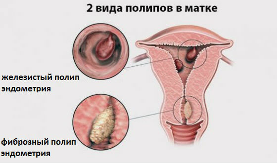 Виды полипозных образований слизистой оболочки матки