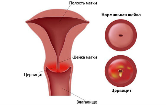 Цервицит как причина болей при менструациях