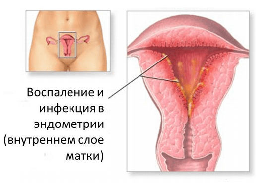 Эндометрит, воспаление слизистой оболочки матки