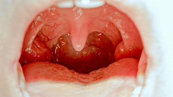 Красное отечное горло характерно для многих заболеваний
