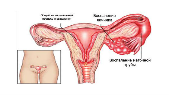 Воспаления женских внутренних половых органов