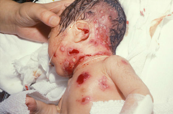 Врожденная герпетическая инфекция у новорожденного