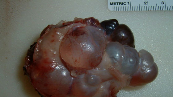 Поликистозный яичник с разными видами кистозных образований