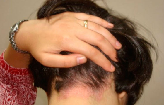 Заболевания кожи головы как причина болезненности