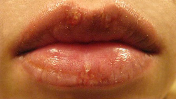 Как заживают губы после перманентного макияжа